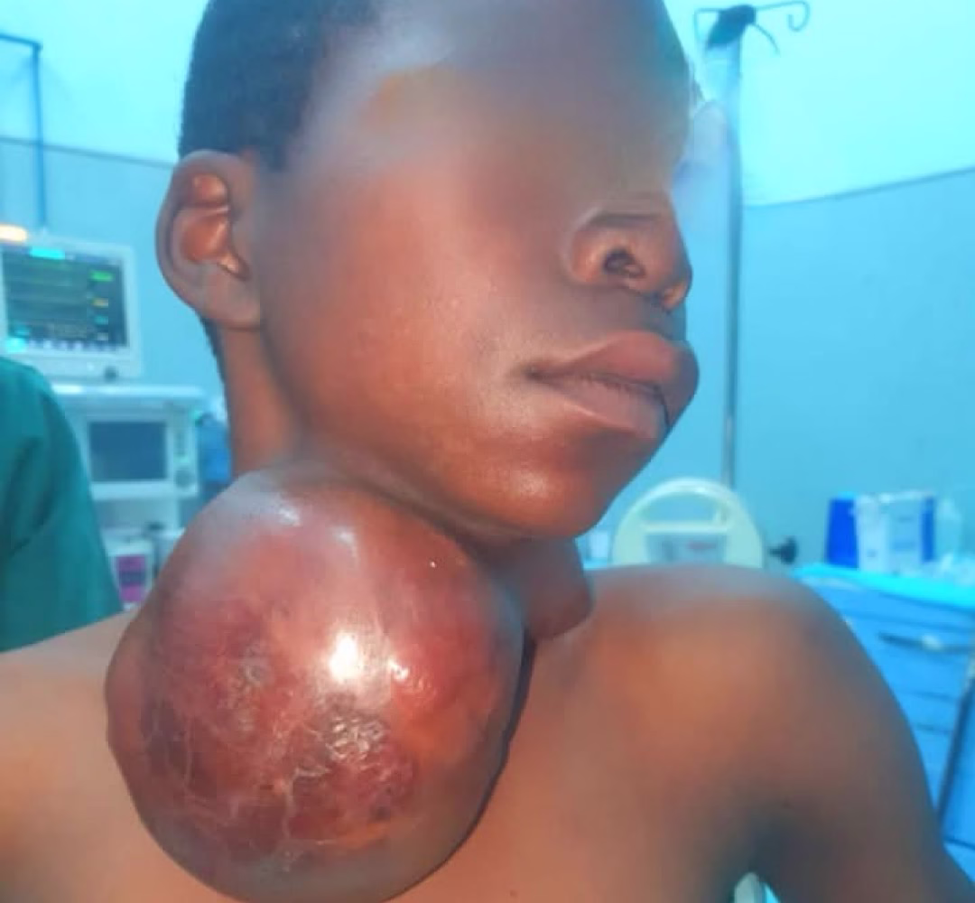Adolescente se recupera após cirurgia para remoção de tumor gigante no pescoço