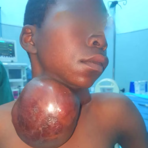Adolescente se recupera após cirurgia para remoção de tumor gigante no pescoço