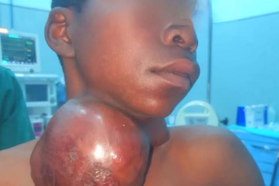 Adolescente se recupera após cirurgia para remoção de tumor gigante no pescoço