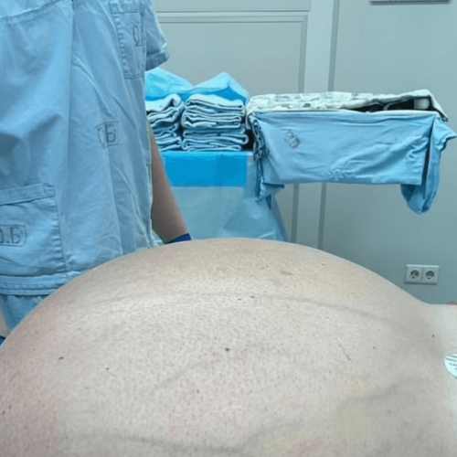 Médicos russos extraem tumor gigante de mais de 60 quilos