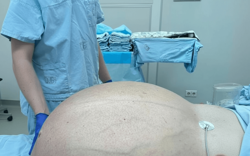 Médicos russos extraem tumor gigante de mais de 60 quilos