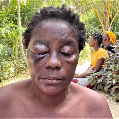 Pemba: Mulher perde olho após agressão brutal do ex-namorado