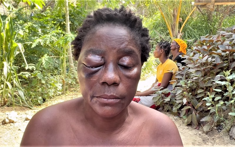 Pemba: Mulher perde olho após agressão brutal do ex-namorado