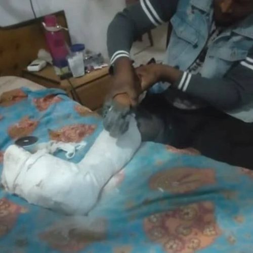 Paciente recorre a rebarbadeira para retirar gesso por falta de equipamento no hospital
