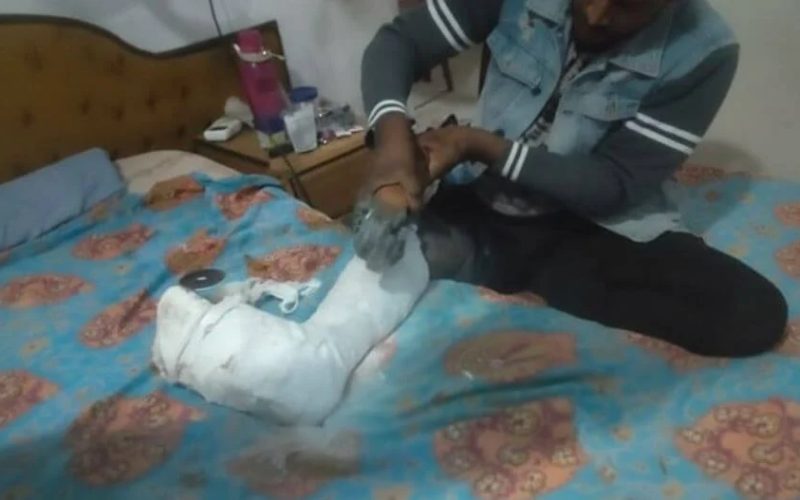 Paciente recorre a rebarbadeira para retirar gesso por falta de equipamento no hospital