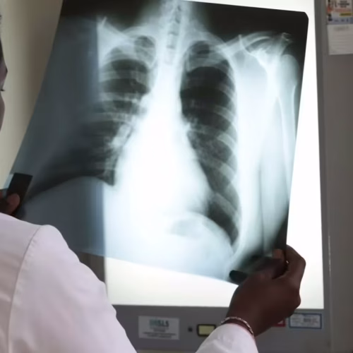 Tuberculose afecta cerca de 125 mil pessoas em Moçambique