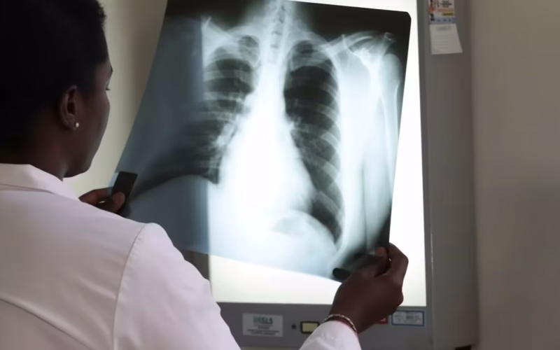 Tuberculose afecta cerca de 125 mil pessoas em Moçambique